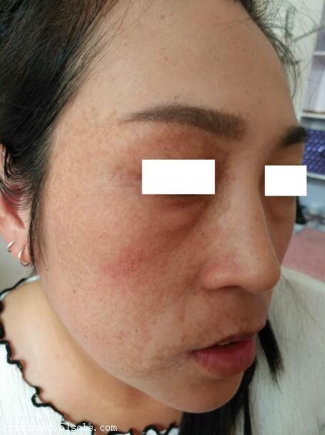 广州伊尔美给大家说说咖啡色胎记吧